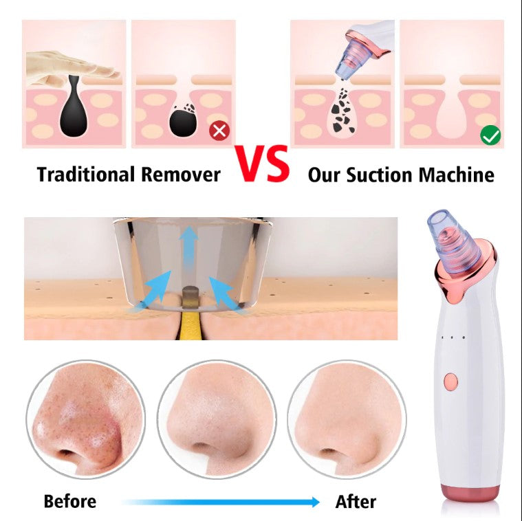 PoreCleanse - Acne Pore Vacuum Suction